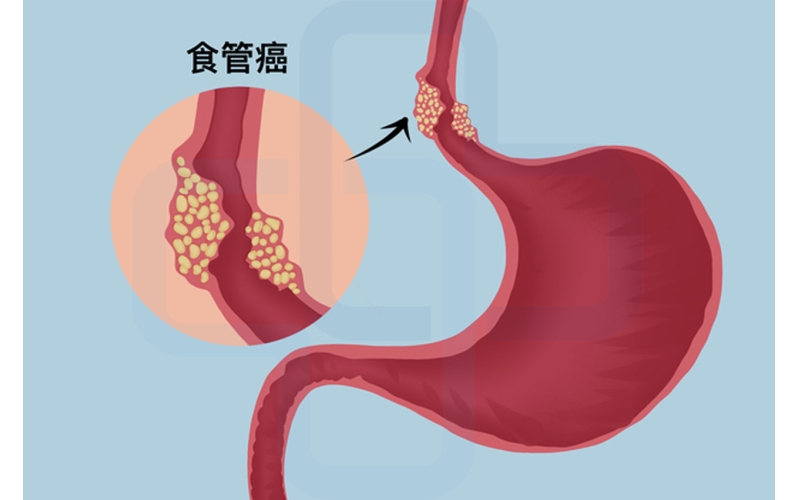 【食管癌】再证实！趁热吃癌症风险增4倍！我国食管癌病例占了一半