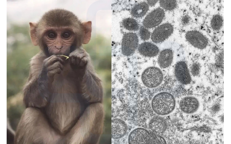【猴痘】多国出现猴痘病毒感染，与天花是近亲，致死率10%