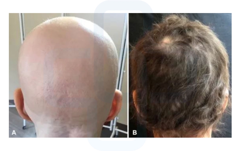 【用药】FDA批准首款口服斑秃疗法，巴瑞替尼